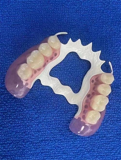 常見(jiàn)的義齒有哪些(圖2)