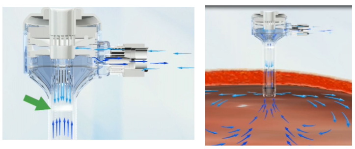 一次性使用腹部穿刺器注冊(cè)審查指導(dǎo)原則(2021年第103號(hào))(圖2) 一次性使用腹部穿刺器注冊(cè)審查指導(dǎo)原則(2021年第103號(hào))(圖2)